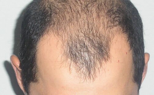 Выпадение волос у мужчин. Причины и лечение медикаментозными и народными средствами #1