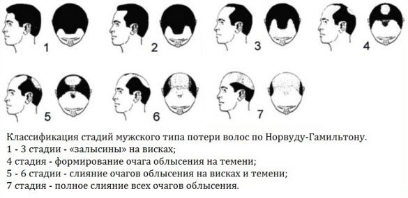 Выпадение волос у мужчин. Причины и лечение медикаментозными и народными средствами #4
